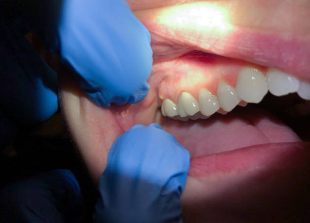 Best Broken Tooth Emergency  in Bay Hill, FL